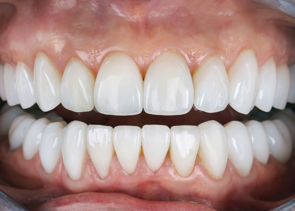 close up of a healthy bright smile showing straight white teeth with perfect alignment and shine ideal for dental health and cosmetic dentistry 4 tips for maintaining oral hygiene