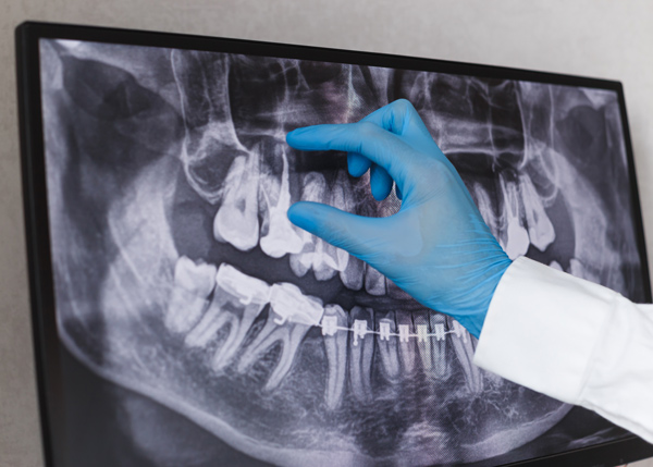 hand in blue glove pointing at dental x-ray showing teeth and jaw bone for oral health inspection