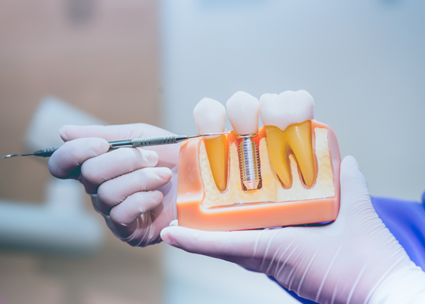 dental implant model with hands demonstrating procedure for tooth replacement and restoration showing eleven tooth structure details